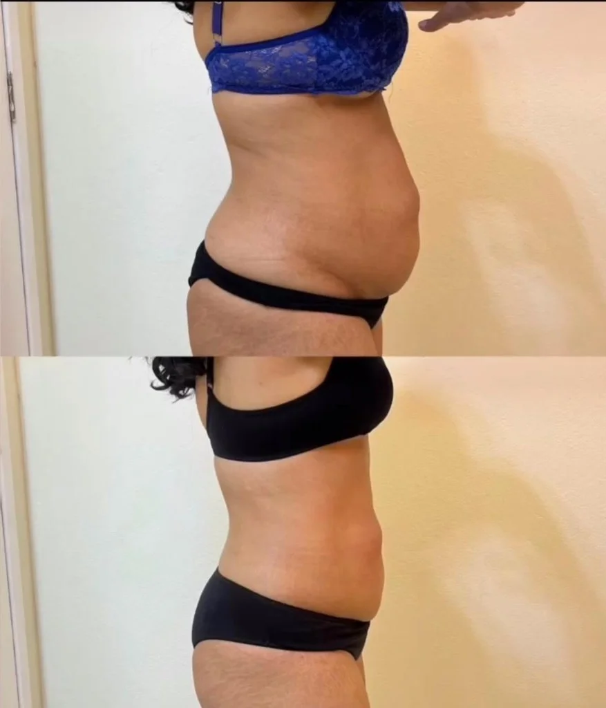 Registro autorizado de antes e depois abdominal em comparação vertical
